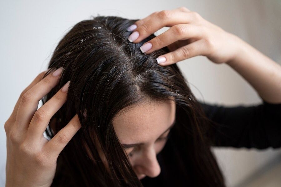 What are The Home Remedies For Dandruff?